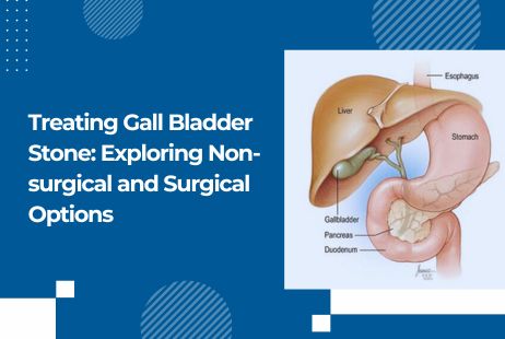 Treating Gall Bladder Stone: Exploring Non-surgical and Surgical Options